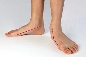 flat foot