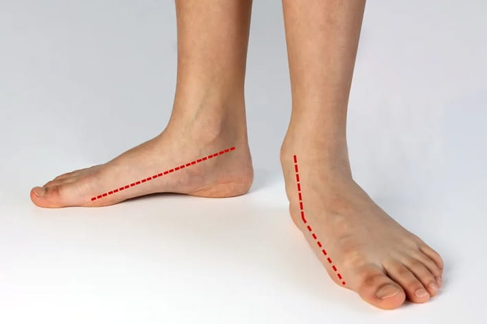 flat foot