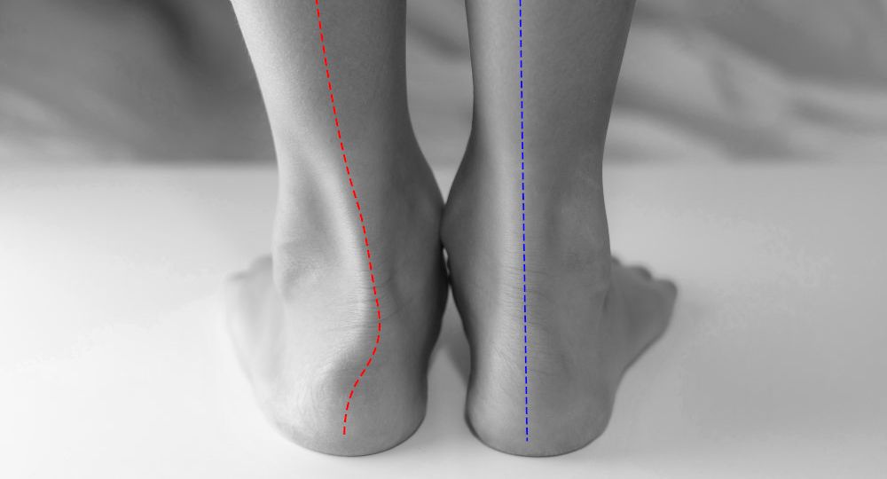 flat foot
