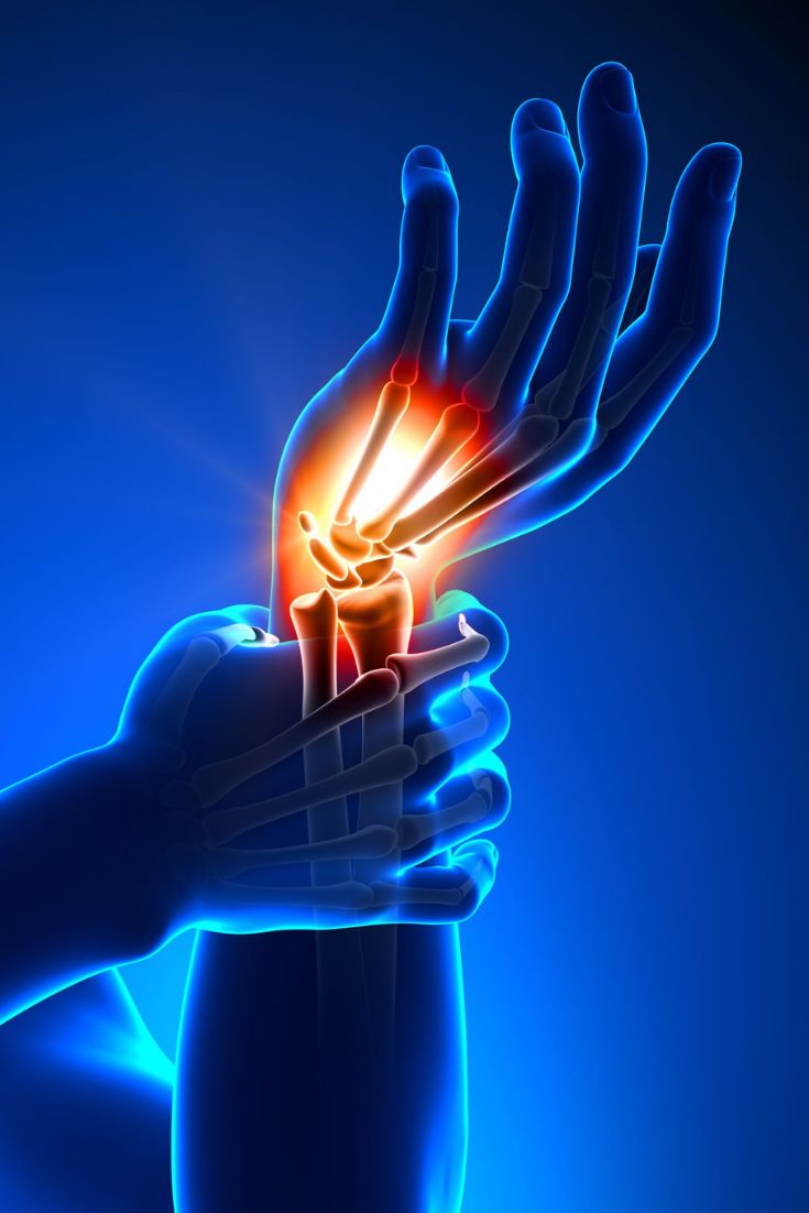 carpal-tunnel-syndrome