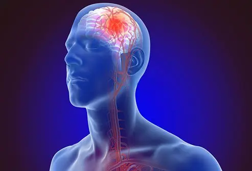 minor-stroke-tanda-&-fisioterapi 1